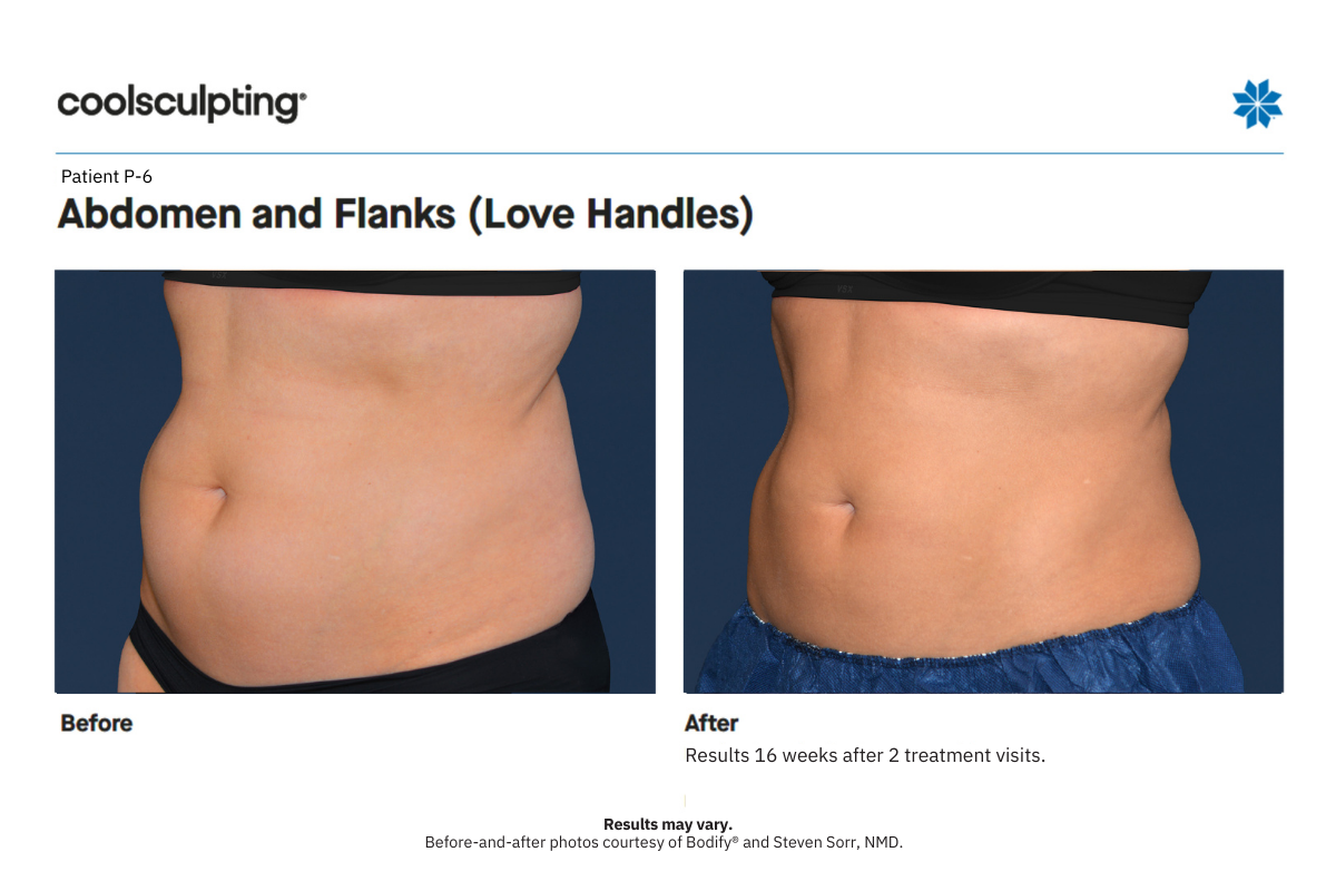 coolsculpting before and after P6 abdomen left 45 coolsculpting before and after P6 abdomen left 45