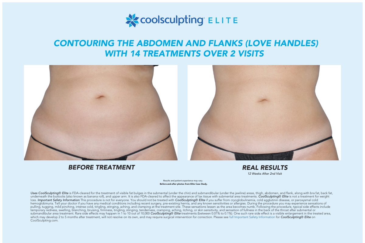 coolsculpting elite before and after abdomen and flanks front view coolsculpting elite before and after abdomen and flanks front view
