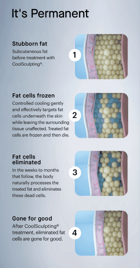coolsculpting elite cryolipolysis infographic