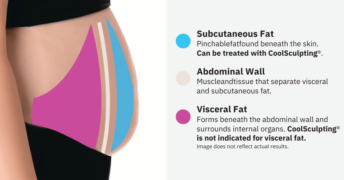 coolsculpting pinchable fat graphic