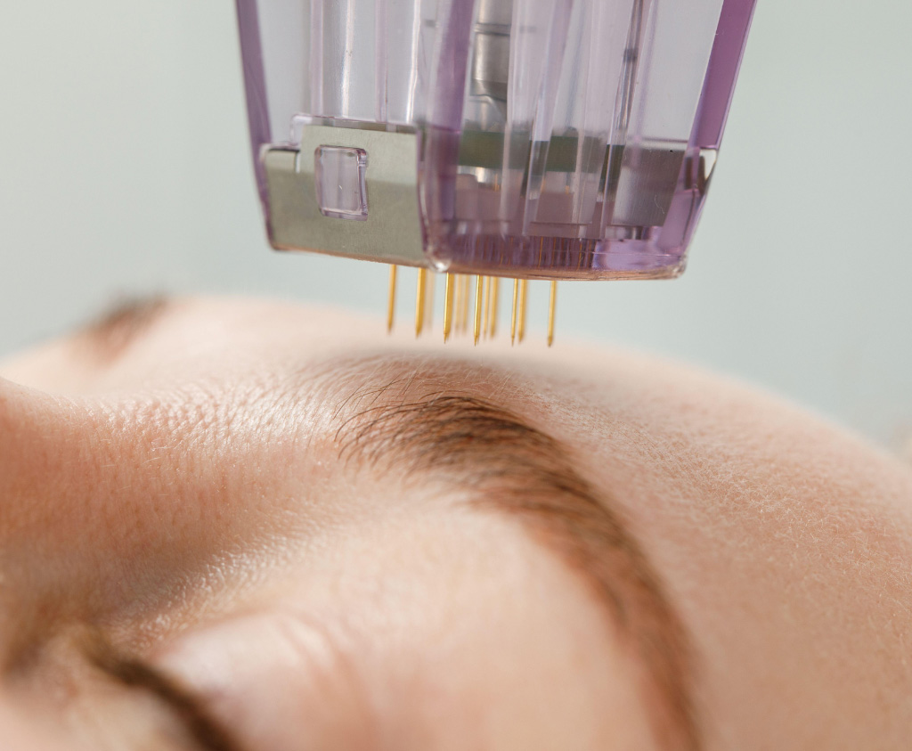 The Morpheus8 Treatment Experience at DSC Laser and Skin Center