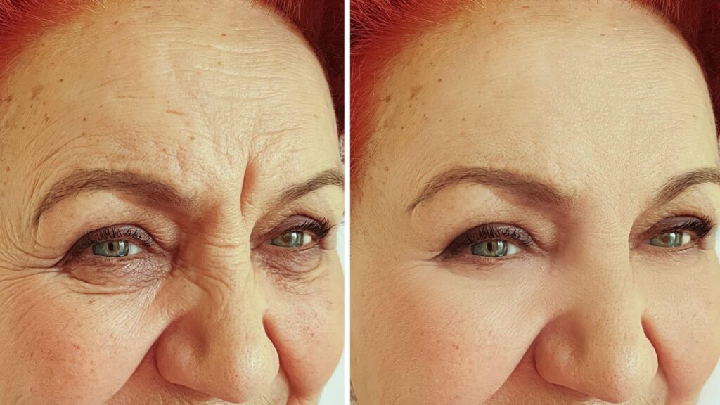 Dermal Fillers Results, Longevity, and Maintenance