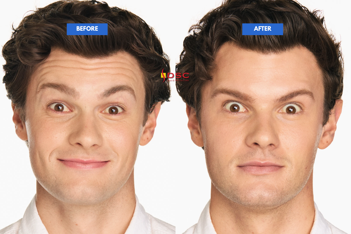 Xeomin Before and After Forehead Preston Xeomin Before and After Forehead Preston