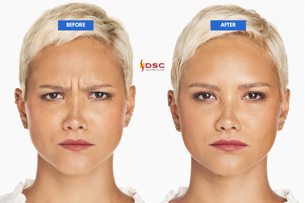 Xeomin Before and After Glabella Frown Lines Alexis Xeomin Before and After Glabella Frown Lines Alexis