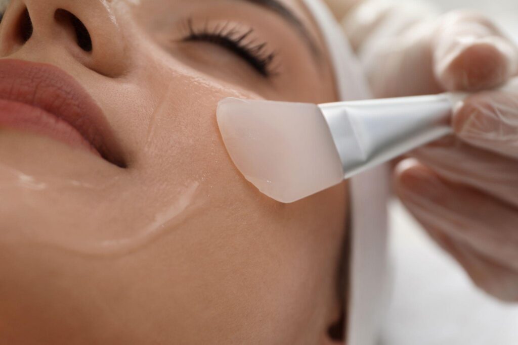 What Is a Chemical Peel?