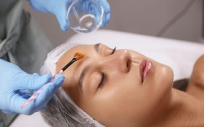 Chemical Peels for Pigmentation in LA: Fade Dark Spots Fast