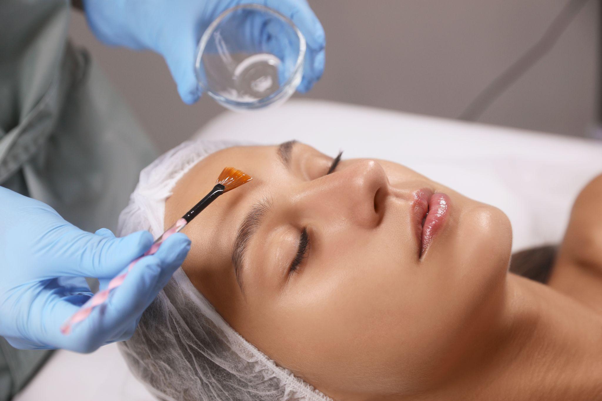 Chemical Peels for Pigmentation in LA: Fade Dark Spots Fast