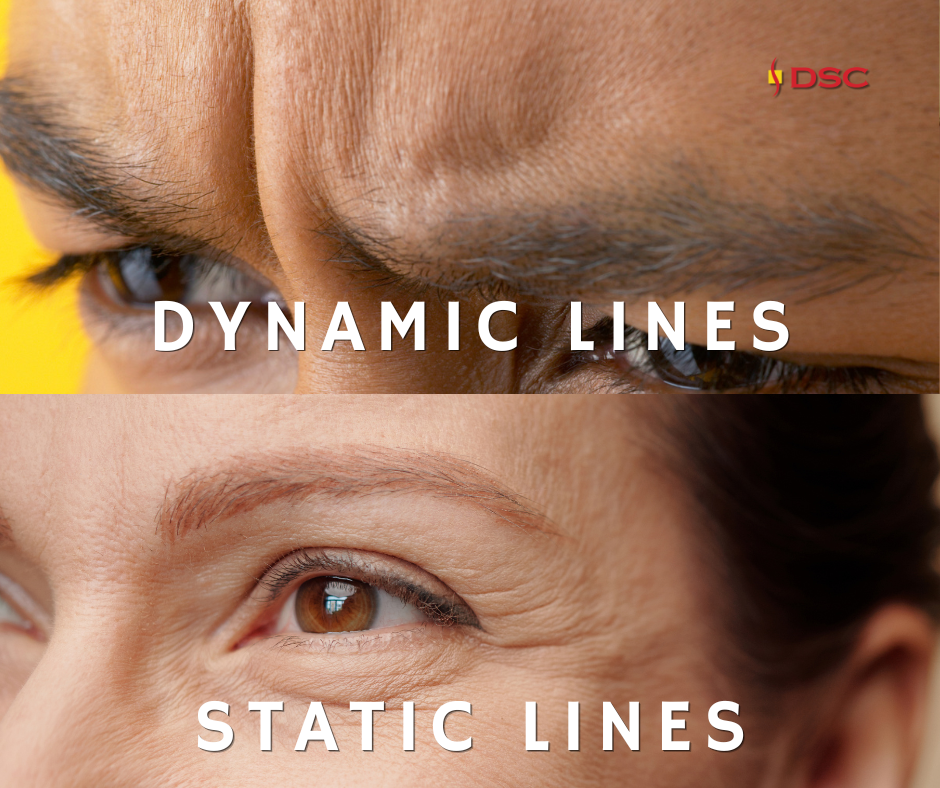 dynamic lines vs static lines blog graphic