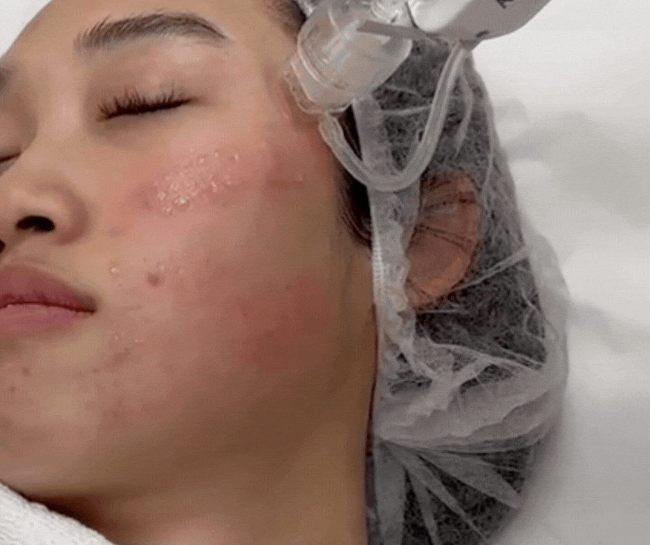 gif of skin booster treatment