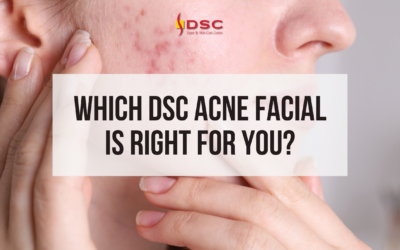Which DSC Acne Facial Is Right For You?