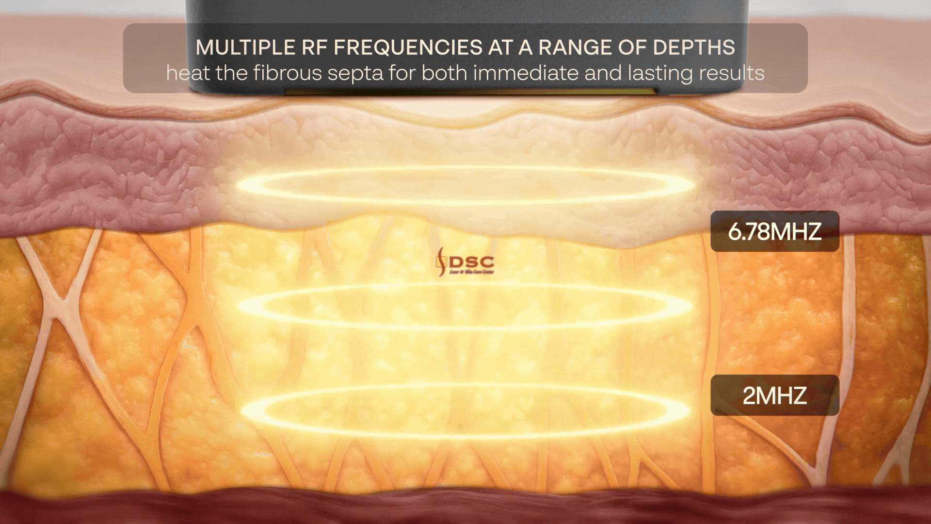XERF dual frequency fibrous septa gif
