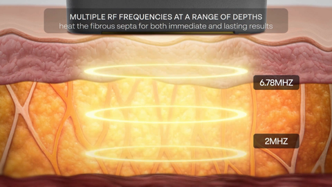 XERF Dual RF Frequency for more comprehensive skin tightening 