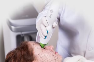 DSC thermage eye treatment for skin tightening of the eyelid and eye contour in Los Angeles and San Gabriel, CA